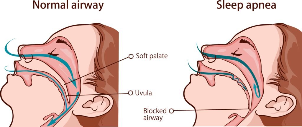 Is Cpap Better Than Oxygen
